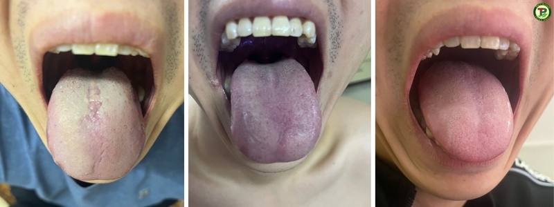 Lưỡi đã đỏ hồng hết sạch nấm và khuẩn hơi thở cũng không còn mùi hôi như trước.